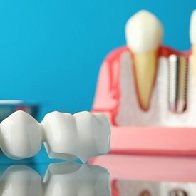 Sample bridge and implant on reflective surface with light blue background