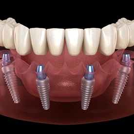 all on 4 dental implants inserted