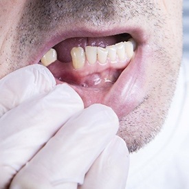 Man with a missing lower tooth