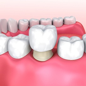 Image of a dental crown on a molar