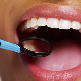 Closeup of smile during dental treatment