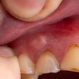 Closeup of dental abscess causing toothache in Wheaton
