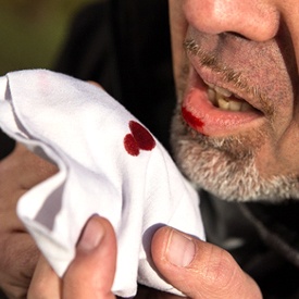 Man going to emergency dental office in Wheaton with bleeding lip