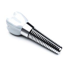 dental implant