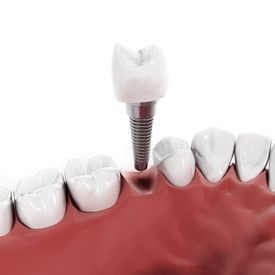 single unit implant