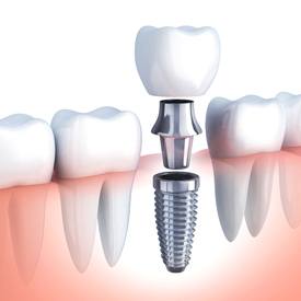 parts of dental implant