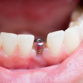 single tooth implant