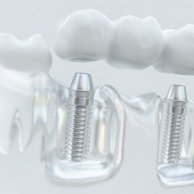 A clear white model jaw with an implant bridge placed, the bridge hovering above the implants