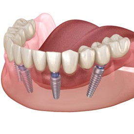 digital illustration of All-On-4 dental implants in the lower jaw