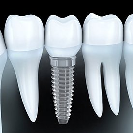 Animation of implant supported dental crown