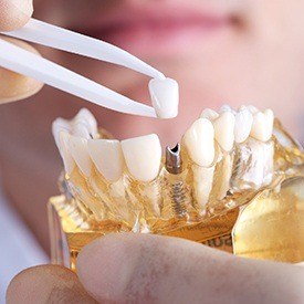 Model smile with implant crown