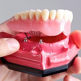 Model of implant supported denture