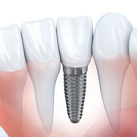 Animation of implant supported dental crown