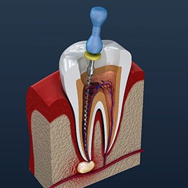 computer illustration of an infected tooth being treated