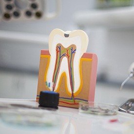 Model of the inside of a damaged tooth