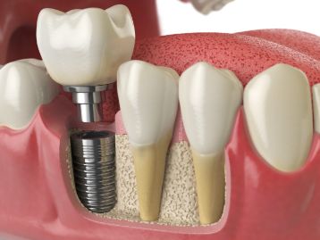 Model of a dental implant in the lower jaw