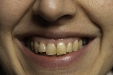 Person with stained teeth