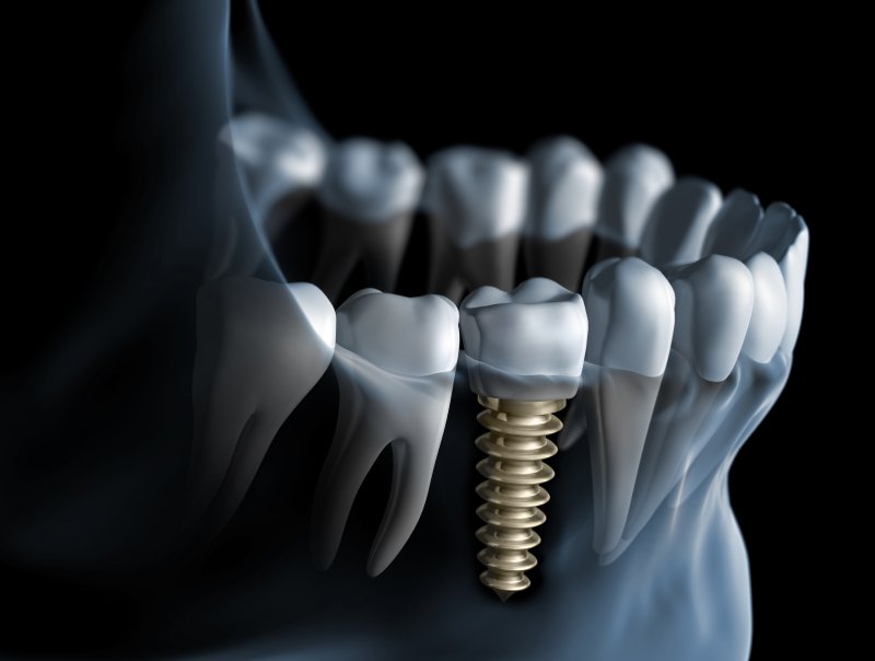 Digital dental implant illustration