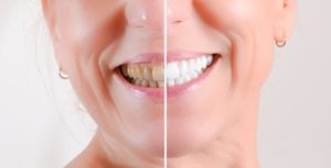 woman smiling before and after teeth whitening 
