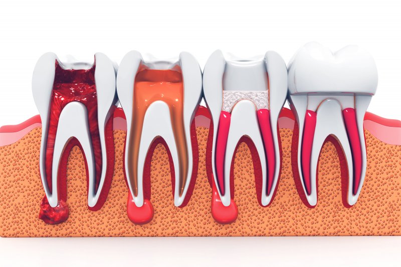 Four-stage root canal treatment illustration