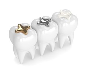 3D rendering of 3 teeth with different dental fillings
