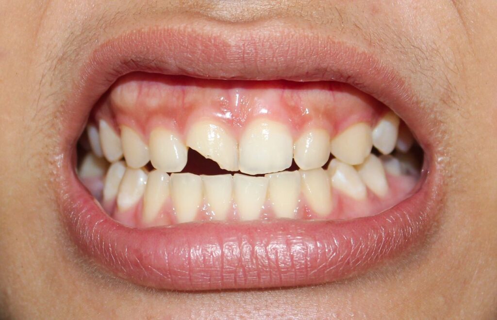 Closeup of someone's mouth with broken front top tooth